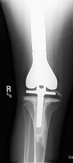 Lower limb salvage prosthesis